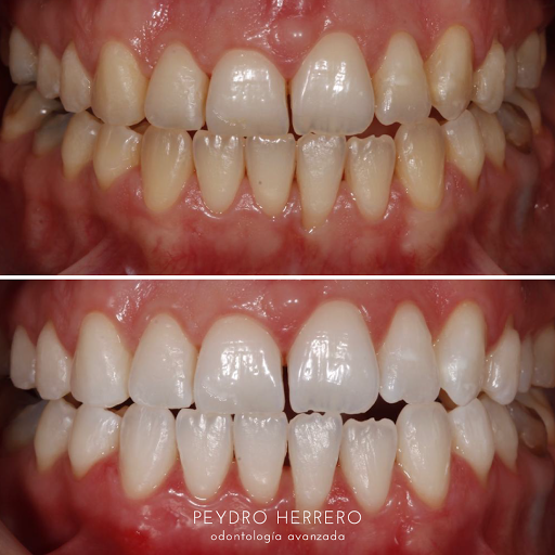 Carillas dentales Valencia - Clinica Dental Dra Adriana Saiz