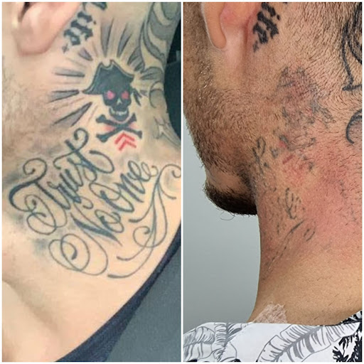 Laser Tattoo Valencia