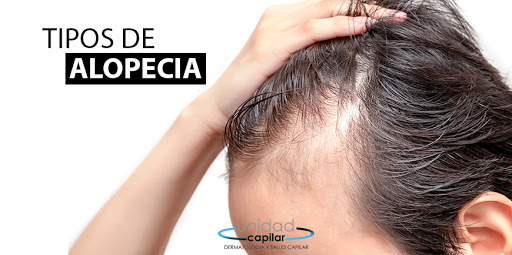 Trasplante de pelo en Valencia,Injerto de cejas, Injerto capilar - Unidad Capilar Corporal Core
